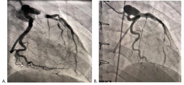 Pulmonary Artery Division for Total Excision and Bypass of Left Main Coronary Artery Aneurysm