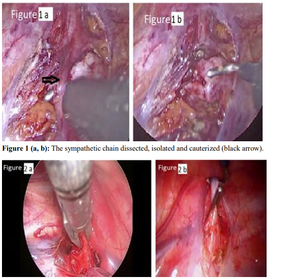 Comparing Electro-Coagulation and Clipping for Palmar Hyperhidrosis in the SamePatient