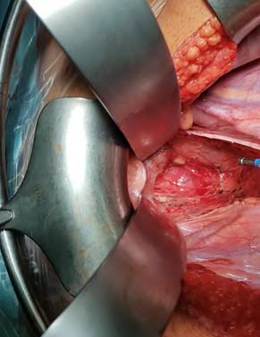 Colorectal Carcinoma – Technique of Resection of Low Located Rectal Carcinomas