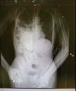 Ruptured Right Hemidiaphragm associated with a Ruptured Spleen after Blunt Assault