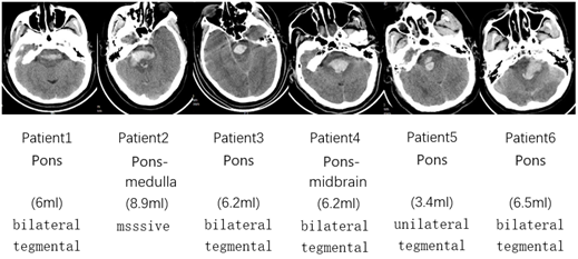 The Neuroendoscopy-Assisted Microscopic Hematoma Evacuation in the Treatment of Hypertensive Brainstem Hemorrhage