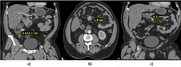 Treatment of Multifocal Neuroendocrine Tumor of the Ileum Whit Lymphatic Metastasis (NETG1) And Low Mutational Burden (TMB).Precision Surgery, Case Report and Review Literature