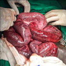 Complicated Sigmoid Colon Volvulus: Case Presentation