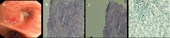 Surgical Treatment for Acute Lung Abscess Secondary to Lung Cancer: A Case Report