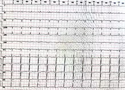 A Patient Complained with Severe Faint Attacks after the Successful Heart-Transplantation