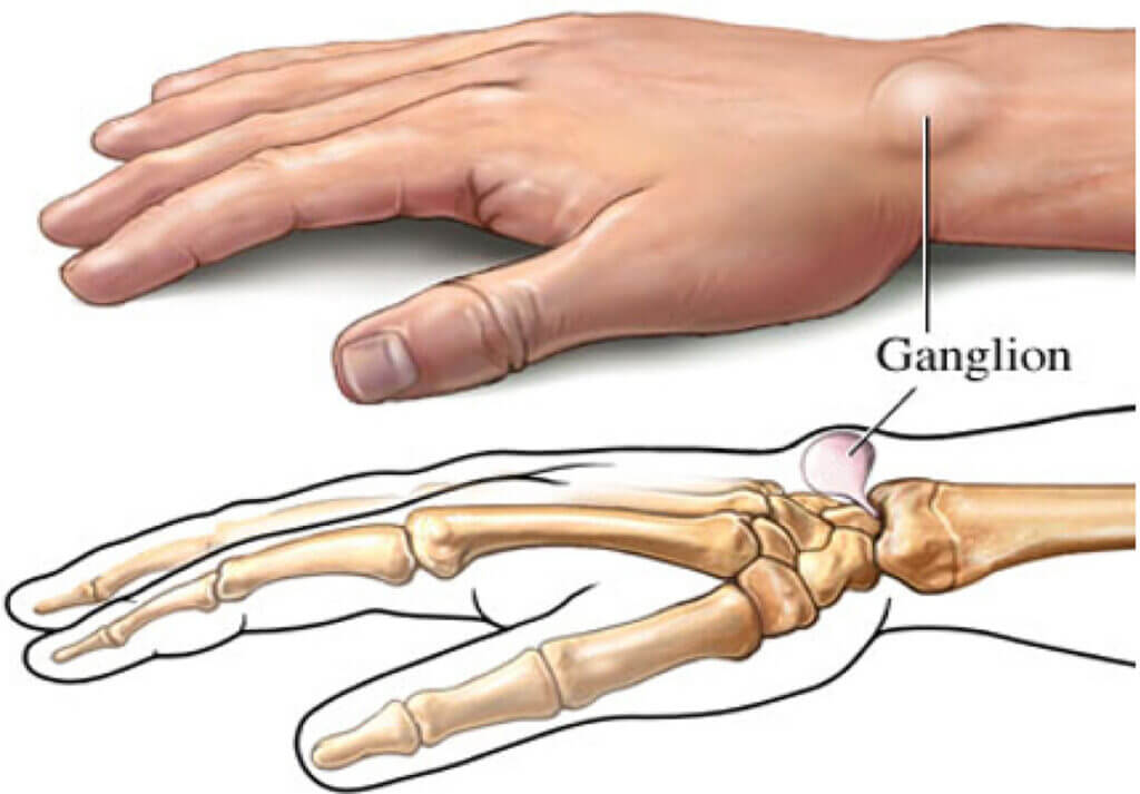 Ganglion Cyst is a Benign Formation