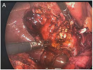 Clinical Outcomes and Treatment Strategy of Mirizzi’s Syndrome Treated with Surgery: A Retrospective Analysis