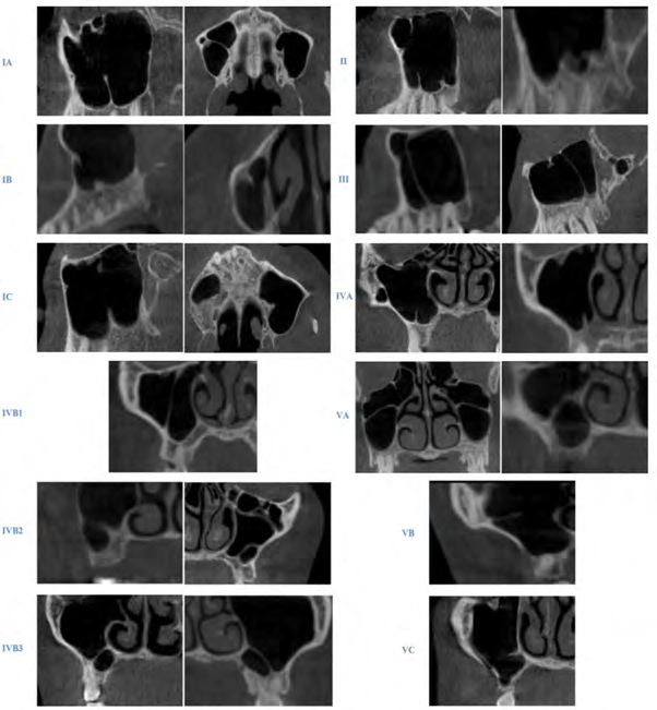 Analysis of Maxillary Sinus Septa using Cone Beam Computed Tomography: A Novel Classification and Clinical Management Proposals