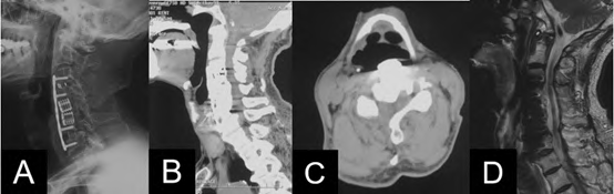 Anterior Controllable Antedisplacement and Fusion as Revision Surgery for the Treatment of OPLL after Anterior and Posterior Decompression: A Case Report