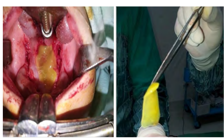 Role of Autologous Platelet Rich Fibrin in Closure of Palatal Fistula