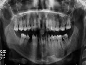 Treatment of Gingival Overgrowth in a Patient with Celiac Disease: A Case Reportwith a 12-Month Follow Up
