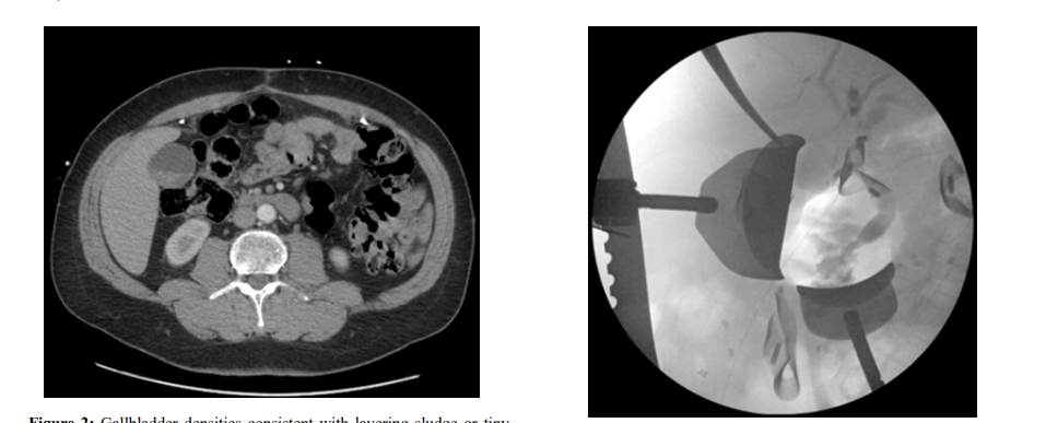 Open Cholecystectomy Post Ventral Mesh Implantation: Surgical Considerations and Case Report