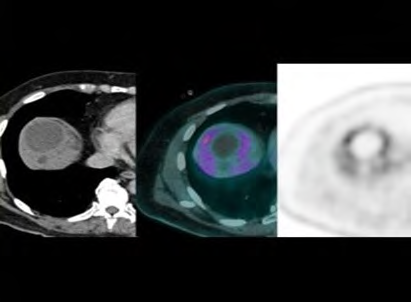 Pyogenic Liver Abscess. Pet-Ct as a New Diagnostic Resource and Suction Drainageas an Effective Therapeutic Method