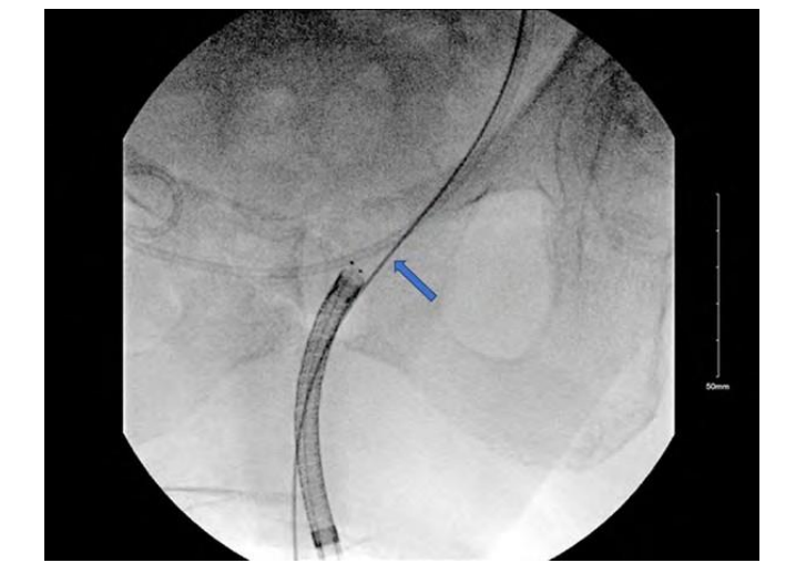 Day Case Ureteric Stent Replacement Under Local Anaesthesia in Both Sexes Using aFlexible Cystoscope and Fluoroscopic Guidance: A Surgical Technique