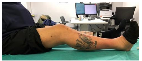 How To Avoid Flexion Contracture after Anterior Cruciate Ligament Reconstruction: An Easy Trick to Perform in The Offic