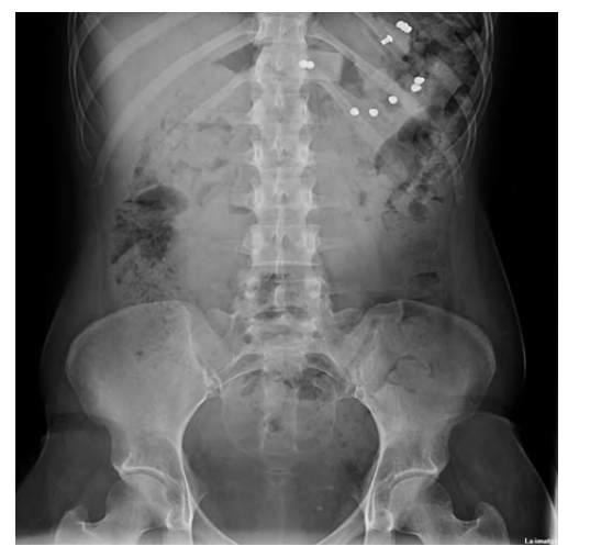 Repeated Behavior of Deliberate Foreign Body Ingestion in a Patient with Psychiatric Disorder. A Case Report