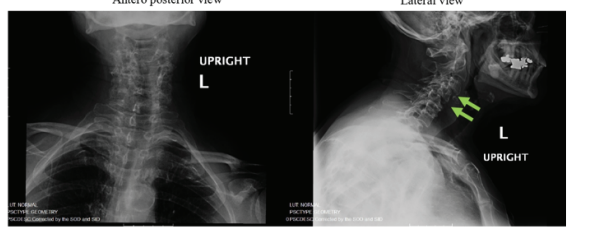 Significant Surgical Improvement in Neurological Function in an Older Femalewith Cervical Spondylotic Myelopathy