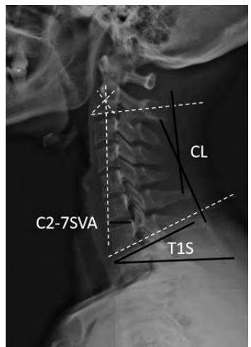 The Change of Matching Between T1 Slope and Cervical Lordosis after Anterior and Posterior Reconstruction Surgeries for Patients with Multilevel Cervical Spondylotic Myelopathy: A Retrospective Study