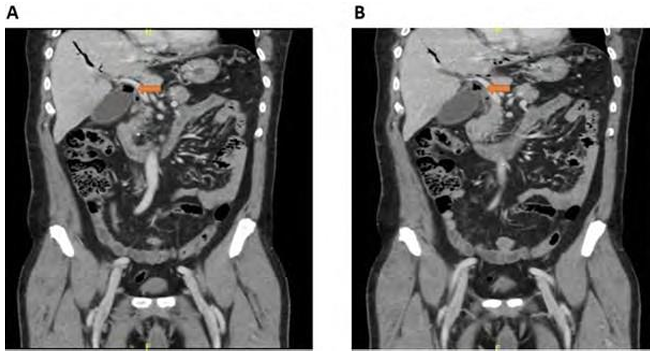 Biliary Cryptococcus Neoformans Manifesting as Obstructive Jaundice Managed by Whipple Surgery: A Rare Case Report