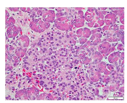 Laparoscopic Near Total Pancreatectomy for Infants with Congenital Hyperinsulinism