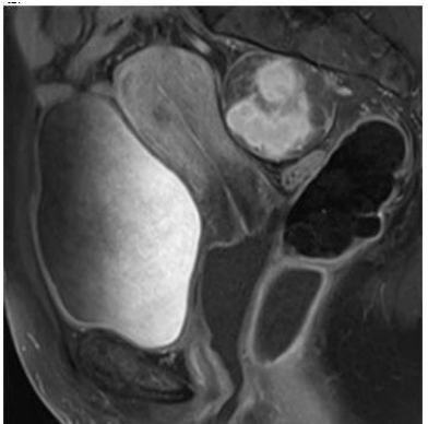 Surgical Neuropelveology: Laparoscopic Nerve-Sparing Excision of A Pelvic Schwannoma Guided by Electrophysiological Study