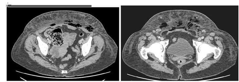 Necrotizing Fasciitis Secondary to TVT Erosion: A Case of Delayed Presentation