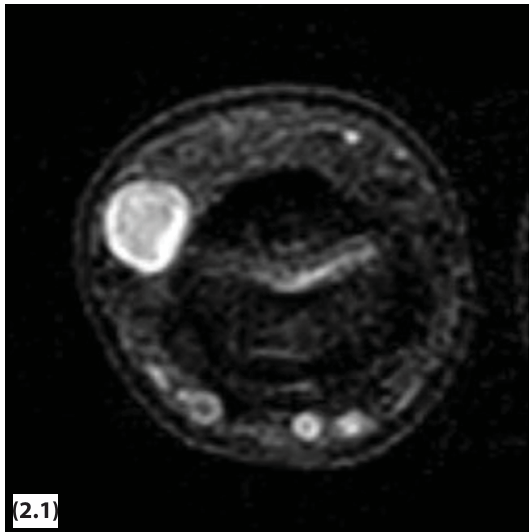 Benign Neurofibroma of a Digital Nerve in A 21-Year-Old Basketball Player: A Case Report