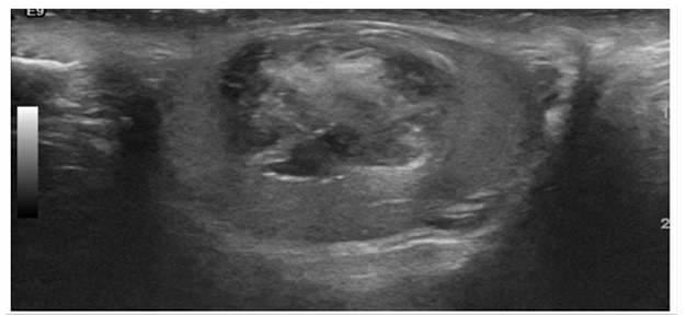 Testicular Preservation for A Testicular Tumor and The Value of Frozen Section