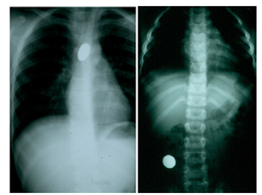Swallowed Foreign Bodies in Children: Diagnosis and Methods of treatment