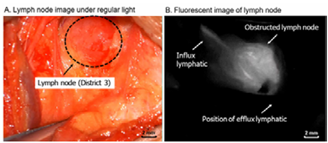 Six Month Study of Therapeutic Effects of Deep Cervical Lymphaticovenular Anastomosisin an Alzheimer’s Disease Patient: A Case Report