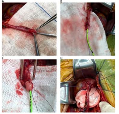 A Novel Ureterovesical Anastomosis Techniques in Adult Kidney Transplantation
