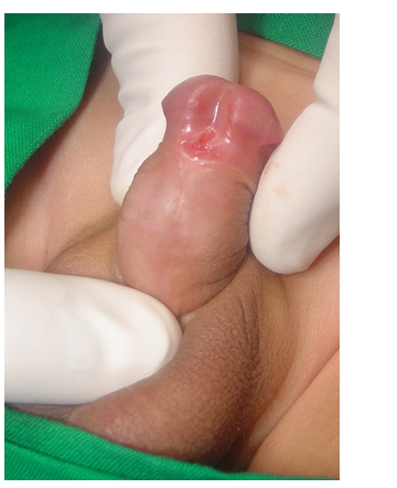 Hypospadias Repair and the Value of Double Dartos Flaps