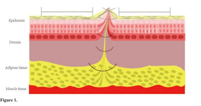 External Tension-Reducing and Decompression Bandaging Suitable for Tension-Reducing Suturing: One Method