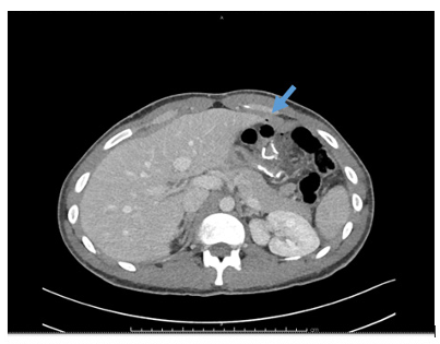 Case Report: Delayed Marginal Ulcer Perforation Five Years Post-Mini Gastric Bypass (one anastomosis gastric bypass) – A Rare Complication with Diagnosticand Therapeutic Implications