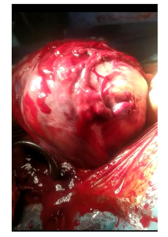 Spontaneous Rupture of Sub-Serous Uterine Vessel in Advanced Gestation: A RareHemorrhagic Cause of Maternal Collapse- A Case Report
