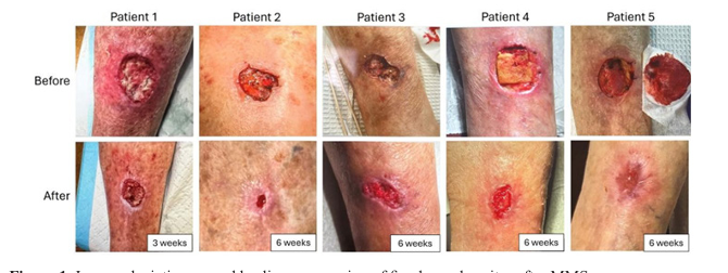 At-Home, Patient-Applied Collagen–Manuka Honey–Hydroxyapatite Dressing for Post- Mohs Surgical Sites: An Eight-Patient Case Series