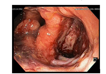 Management of Chronic Pelvic Sepsis Complicating Rectal Cancer Surgery