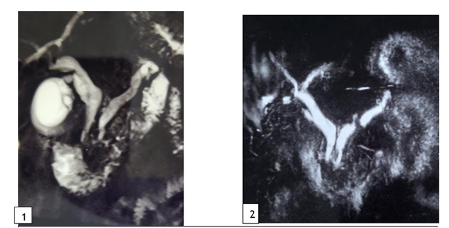 Persistent Double Duct Sign Following CBD Stone Removal and Cholecystectomy: A Benign Course in a Malignant Mimic