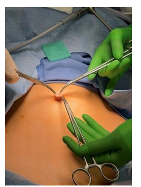 Safe and Aesthetic Laparoscopic Access Achieved with 5-mm Open Entry