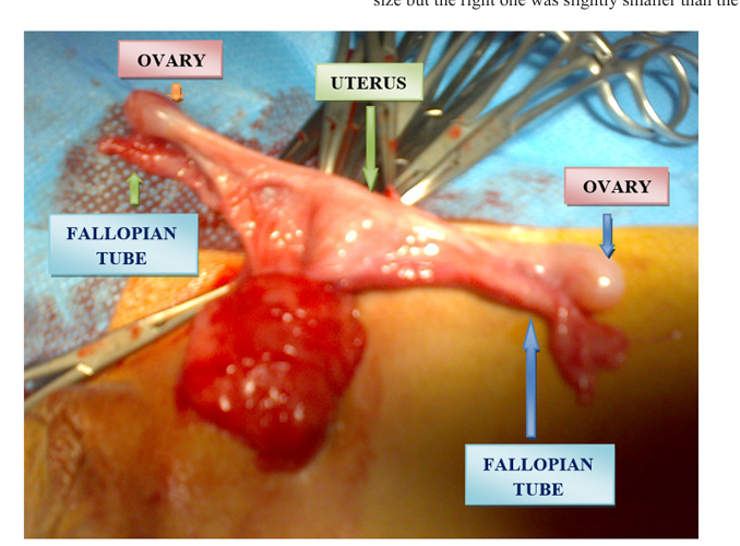 Undescended Testes: The Hidden Normal or Abnormal Anatomy and The Value of Laparoscopy