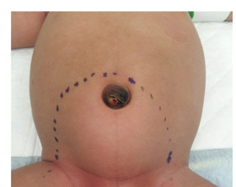 Hydrocolpos: Etiology, Diagnosis and Management