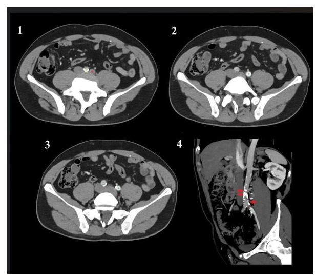 A “Way Too Effective” Compensation with in the Leriche Syndrome. A Case Report