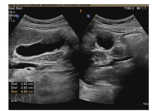 Case Report and Review of Primary Gallbladder Gastrointestinal Stromal Tumour
