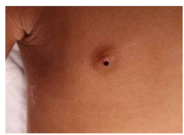 Breast Enlargement in Male Infants and Children: Two Unusual Causes