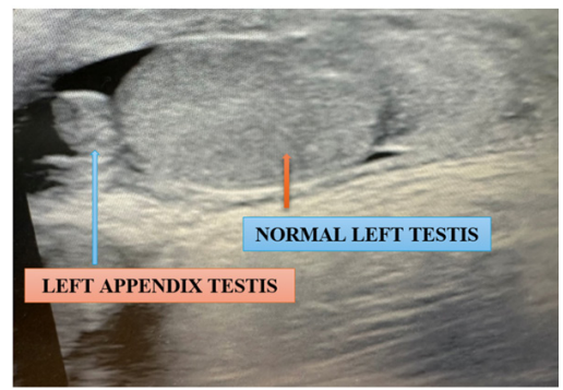Testis Appendix of Torsion Perinatal