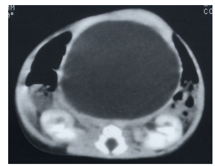 McKusick-Kaufman Syndrome: A Report of Four Cases