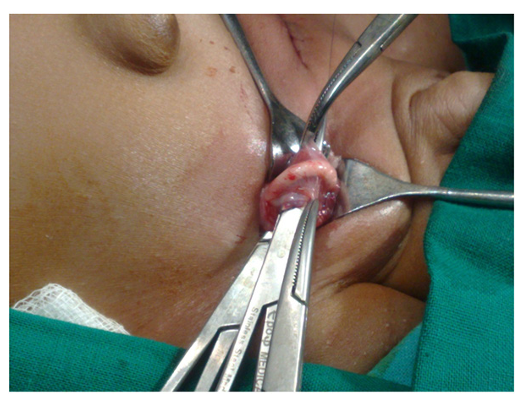 Migration of A Ventriculoperitoneal Shunt into An Inguinal Hernia Sac in An Infant. A Case Report and Review of The Literature