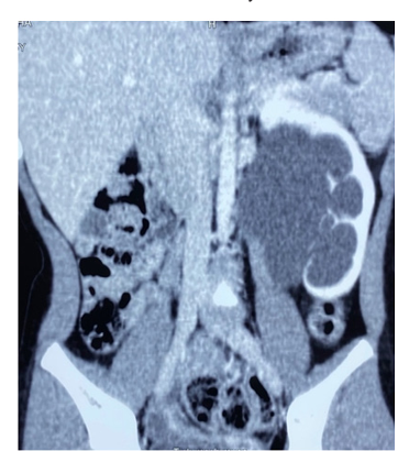 A Novel Non-Dismembering Technique to Advance the Ureteral Insertion for UreteropelvicJunction Obstruction Caused by High Ureteral Insertion: A Case Report